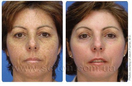microlaserpeel-3