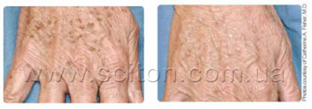 phototherapy-2
