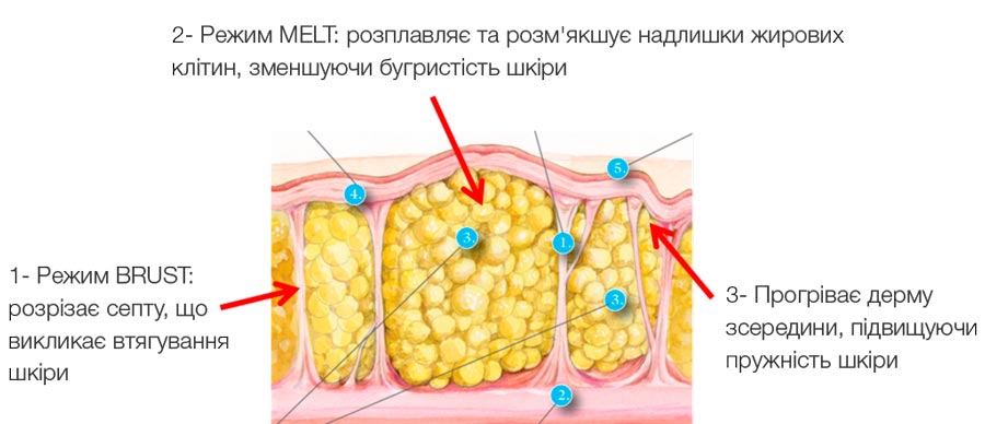 лікування целюліту CelluSmooth Sciton